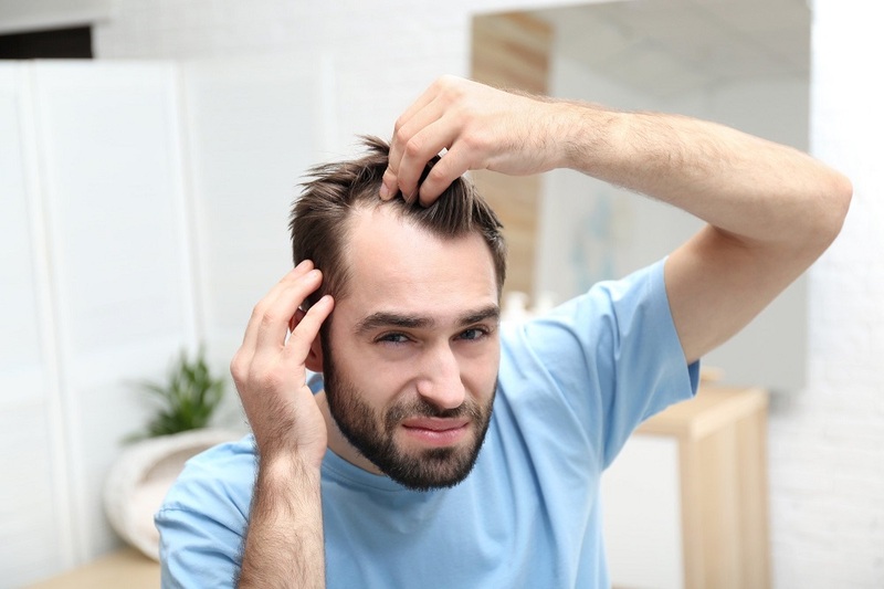 receding hairline